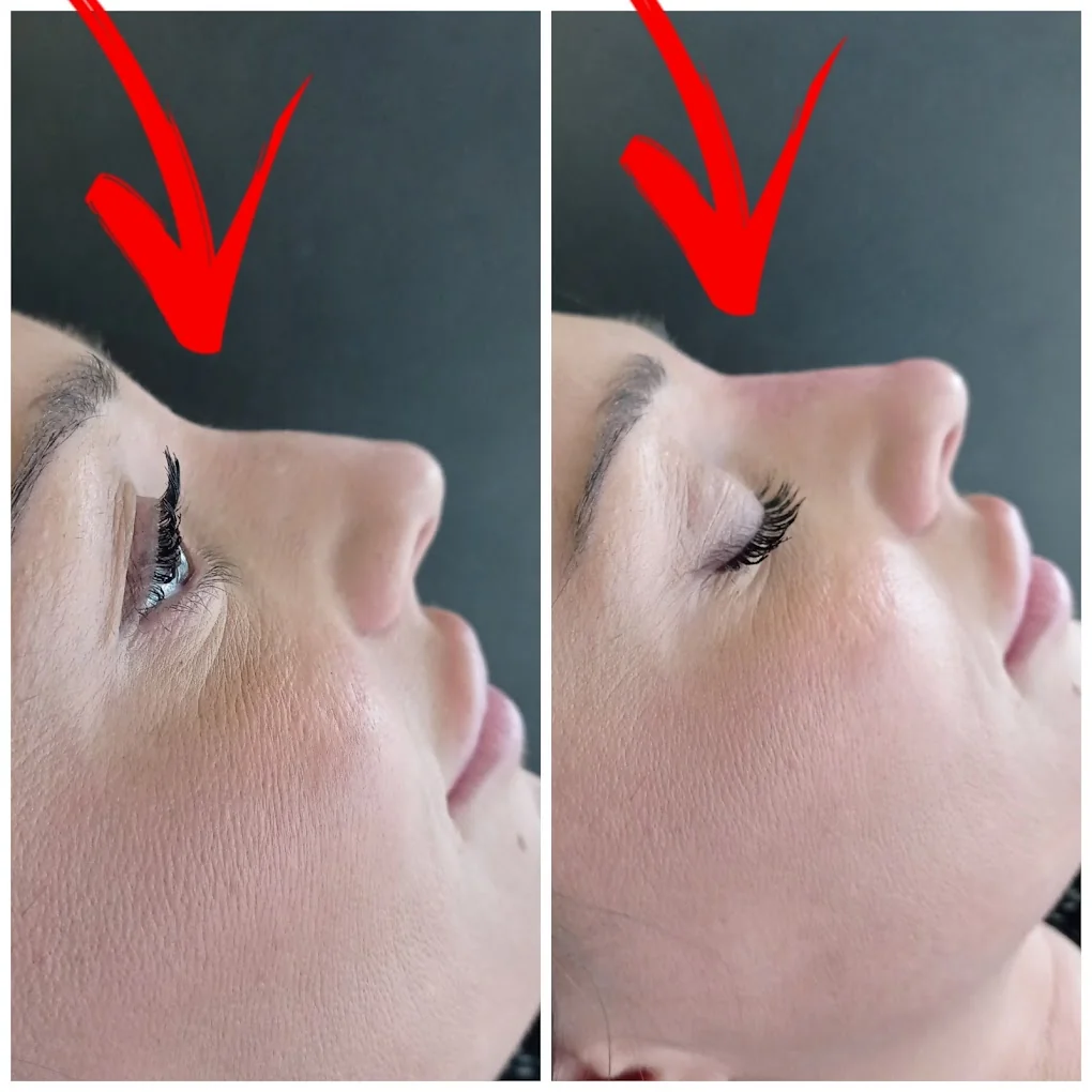 Transform Your Look with Non-Surgical Rhinoplasty in Colchester