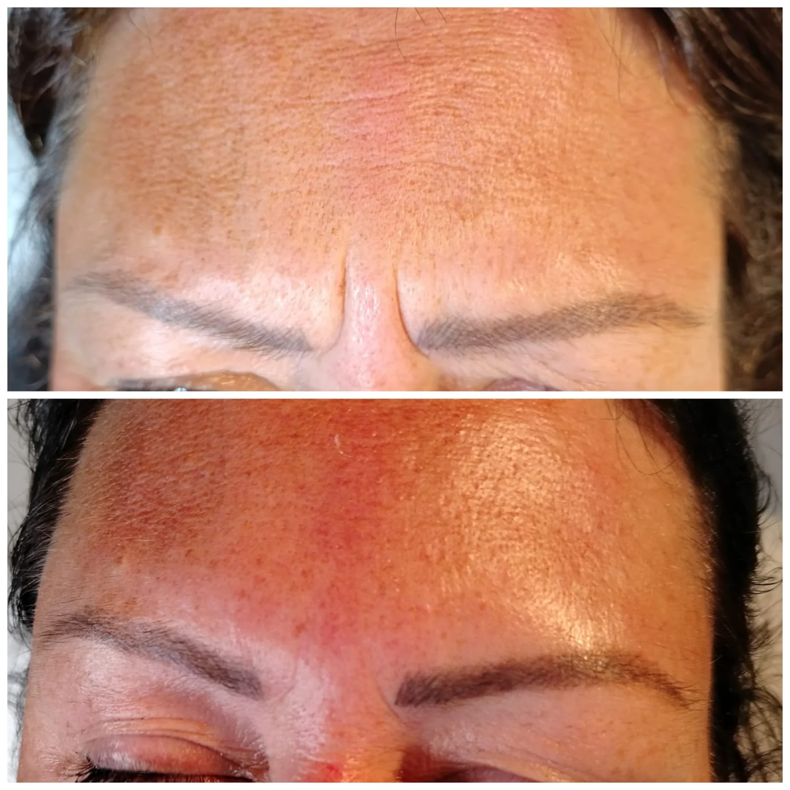Anti-Wrinkle Treatment Before and After - Smooth Forehead and Reduced Fine Lines