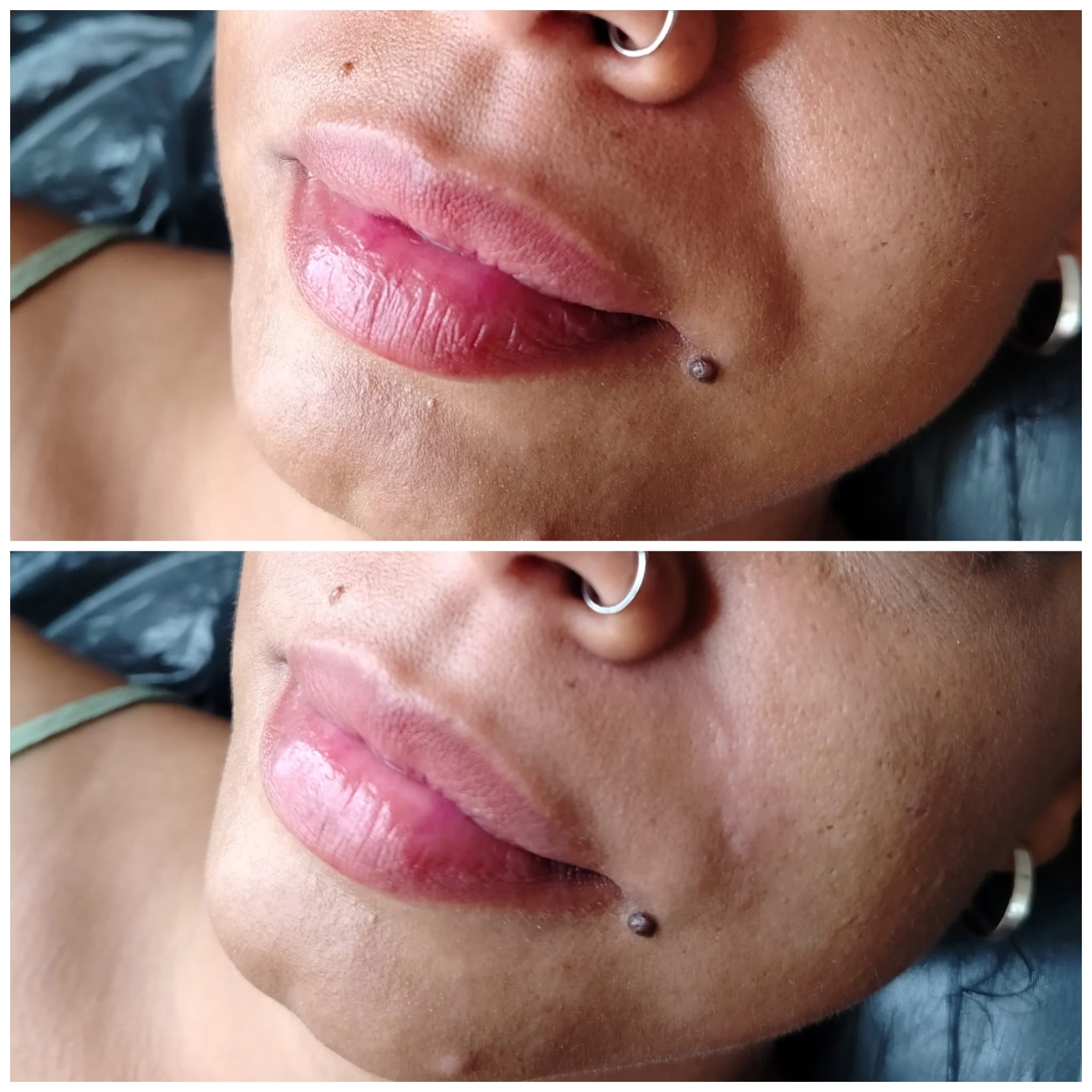 Non-Surgical Rhinoplasty Before and After Results at Hidden Beauty Colchester